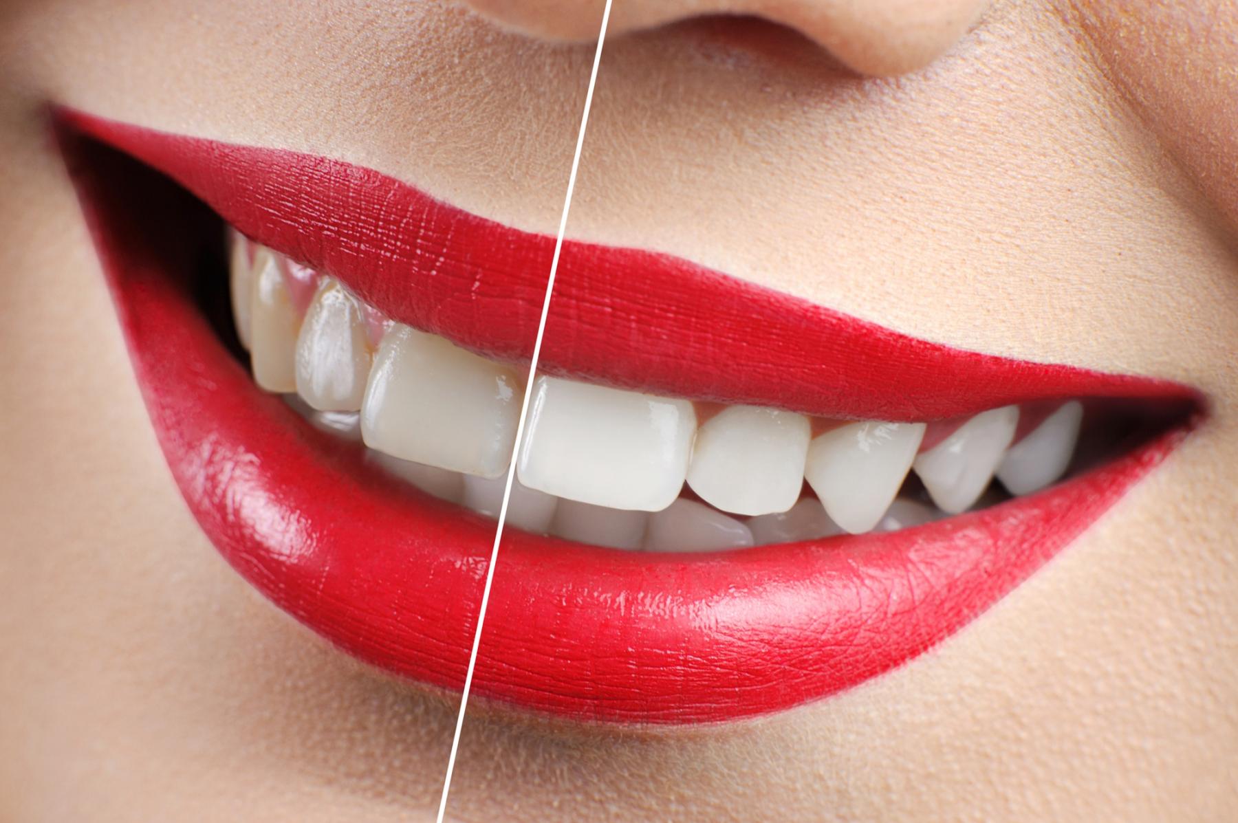 Blanqueamiento dental
