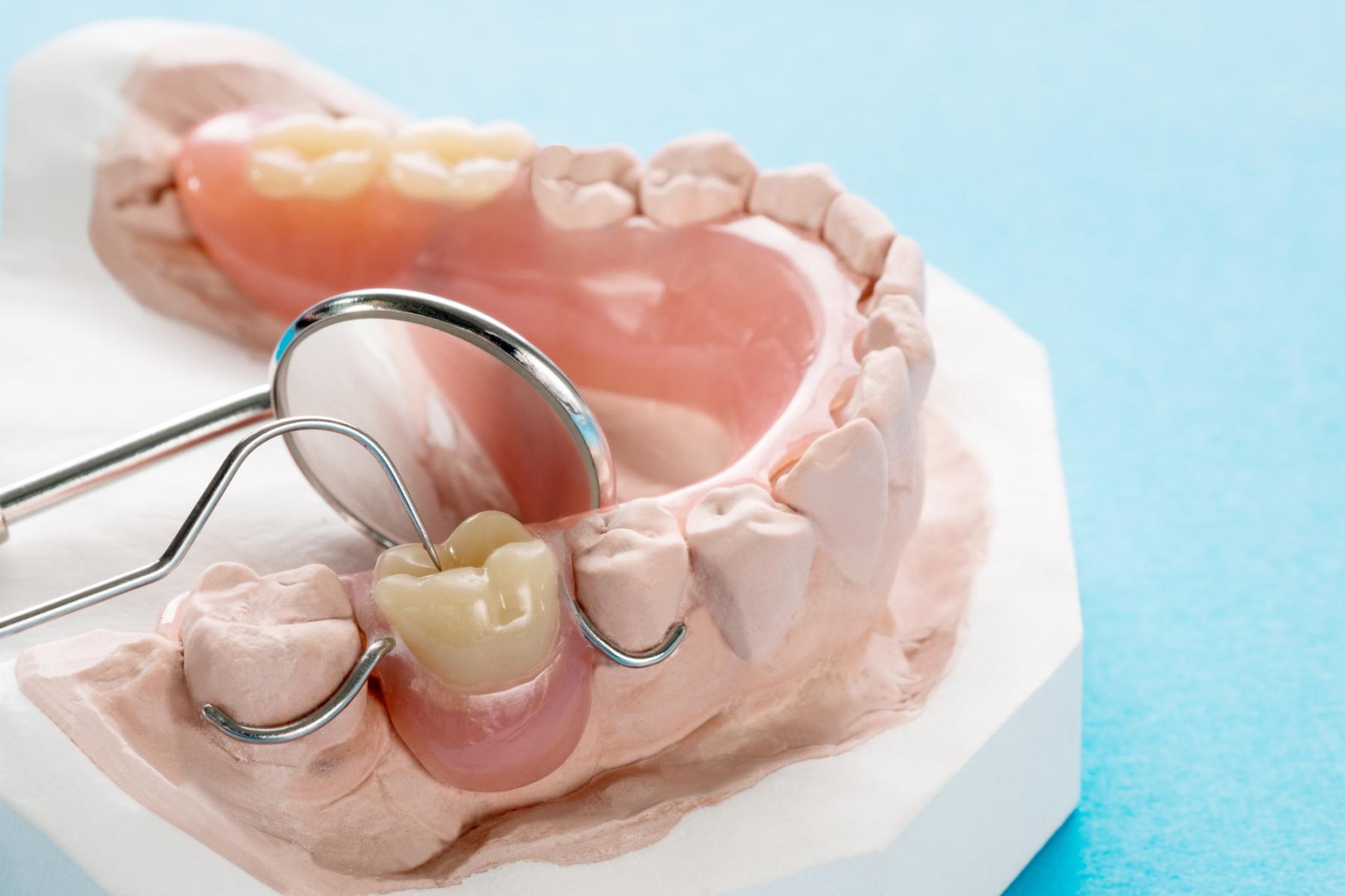 Prótesis dental